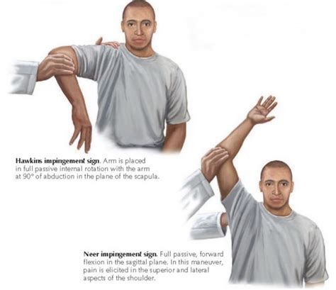 rotator cuff tear physical exam